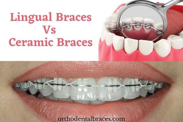 Lingual Braces Vs Ceramic Braces – What you need to know before choosing one?