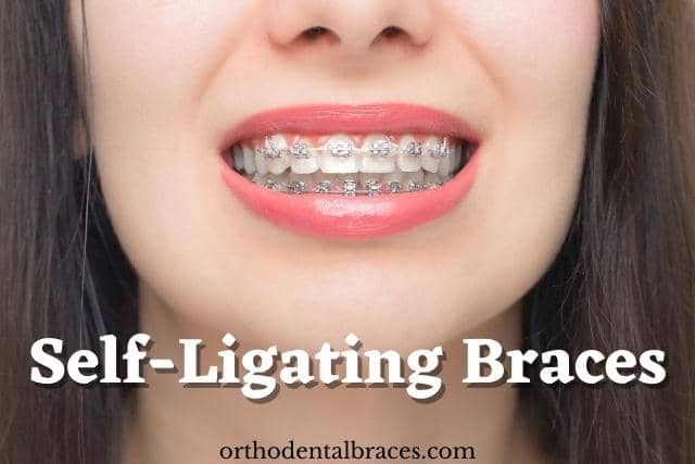 Everything about Self-ligating braces