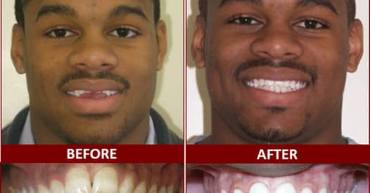 before and after ceramic braces