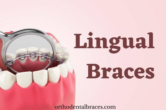 Everything About Lingual Braces
